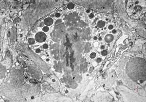 M,11y. | fibrillary astrocytoma